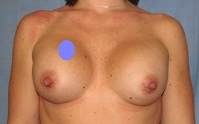 Breast Augmentation