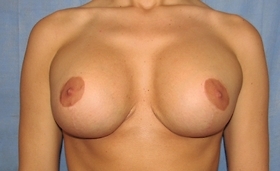 Breast Augmentation