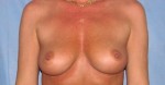 Breast Augmentation