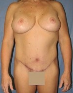 Tummy Tuck