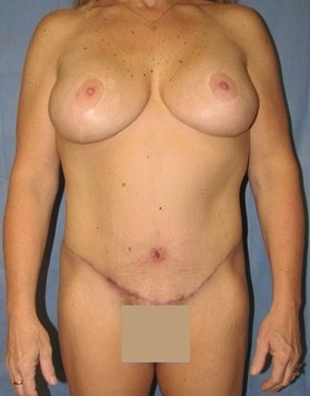 Breast Augmentation