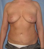 Breast Reduction/Breast Lift