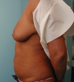 Breast Reduction/Breast Lift