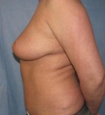 Breast Reduction/Breast Lift