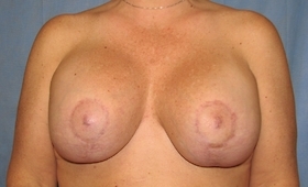 Breast Lift