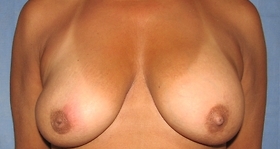 Breast Reduction/Breast Lift