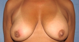 Breast Lift