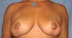 Breast Reduction/Breast Lift