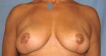 Breast Lift