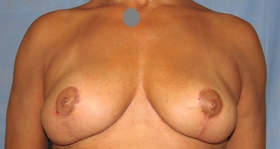 Breast Reduction/Breast Lift