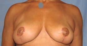 Breast Lift