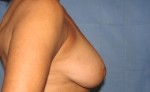 Breast Reduction/Breast Lift