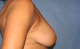 Breast Reduction/Breast Lift