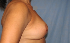 Breast Reduction/Breast Lift