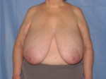 Breast Reduction/Breast Lift