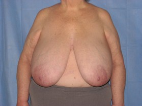 Breast Reduction/Breast Lift