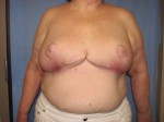 Breast Reduction/Breast Lift