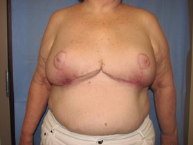 Breast Reduction/Breast Lift