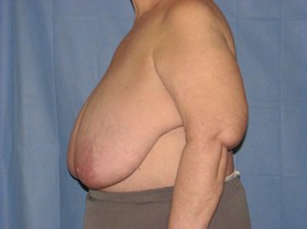 Breast Reduction/Breast Lift