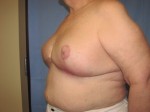 Breast Reduction/Breast Lift