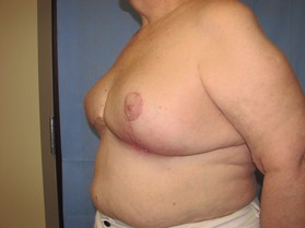 Breast Reduction/Breast Lift