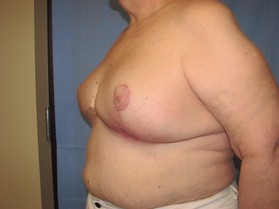 Breast Reduction