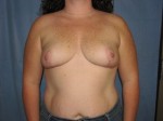 Breast Reduction/Breast Lift
