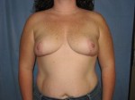 Breast Reduction