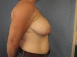 Breast Reduction/Breast Lift