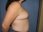 Breast Reduction/Breast Lift