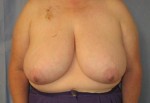 Breast Reduction/Breast Lift