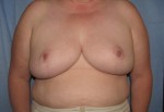 Breast Reduction/Breast Lift