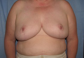 Breast Reduction