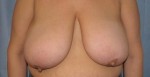 Breast Reduction/Breast Lift