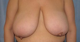 Breast Reduction/Breast Lift