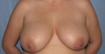 Breast Reduction/Breast Lift