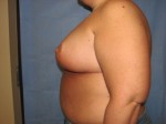 Breast Reduction/Breast Lift