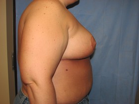 Breast Reduction