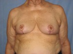Breast Reduction/Breast Lift