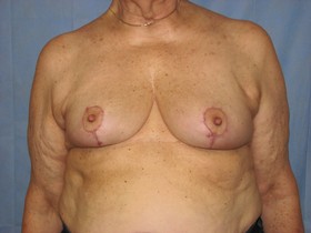 Breast Reduction/Breast Lift