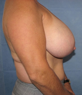 Breast Reduction/Breast Lift