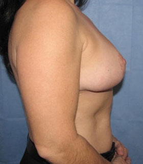 Breast Reduction/Breast Lift