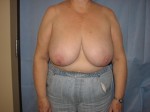 Breast Reduction/Breast Lift