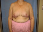 Breast Reduction/Breast Lift