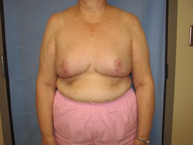 Breast Reduction