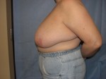 Breast Reduction/Breast Lift