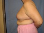 Breast Reduction/Breast Lift