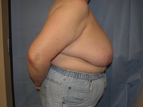 Breast Reduction