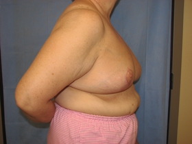 Breast Reduction