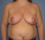 Breast Reduction/Breast Lift